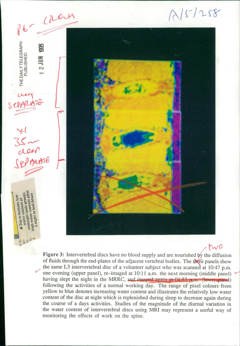 Body scanners:intervertebral disc have no blood supply - Vintage Photograph