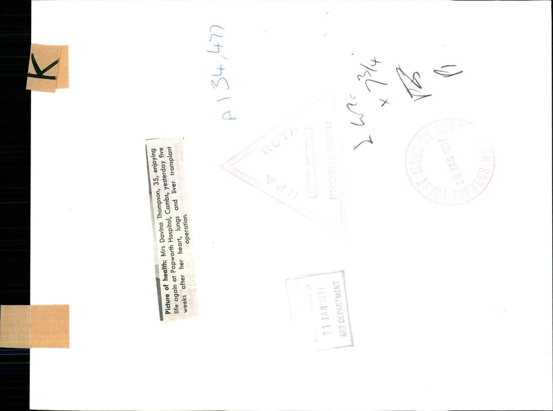 MRS DAVINA THOMPSON HAD HER HEART LUNGS AND LIVER TRANSPLANTS FIVE WEEKS - Vintage Photograph