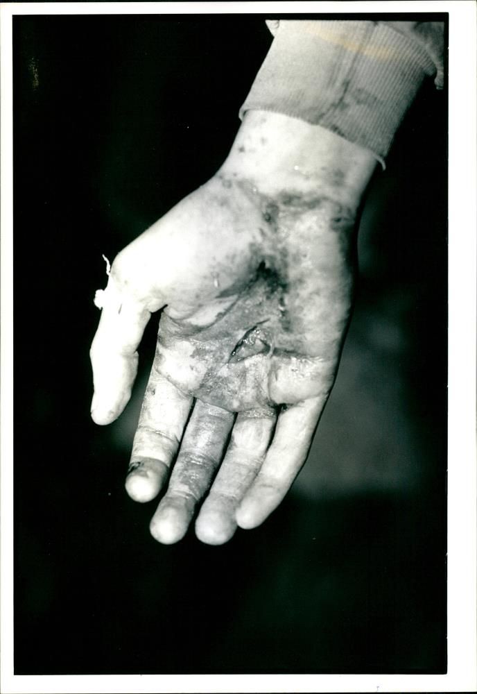 Bloody Hand - Vintage Photograph